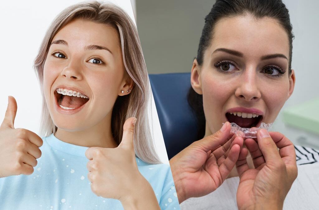 Alineadores vs. Brackets